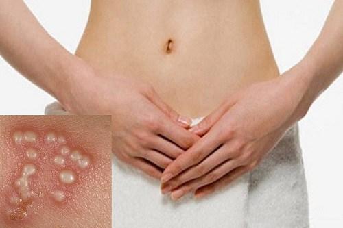 1734535913816334.jpg herpes-la-benh-gi2.jpg