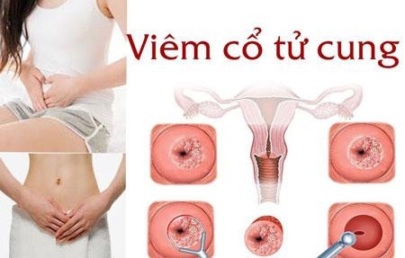 1734612949745420.jpg 5dddf7c2bfebd81192902820_cach-dieu-tri-viem-co-tu-cung.jpg